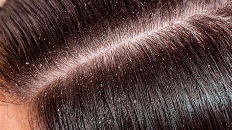 Caspa seca blanca sobre cabello oscuro