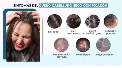 Inflamación y exudación del cuero cabelludo