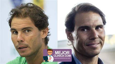 Famosos antes y después trasplante capilar