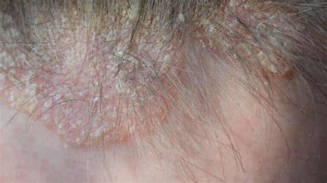 Psoriasis del cuero cabelludo con placas gruesas