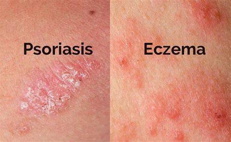 Comparación de escamas psoriasis dermatitis seborreica
