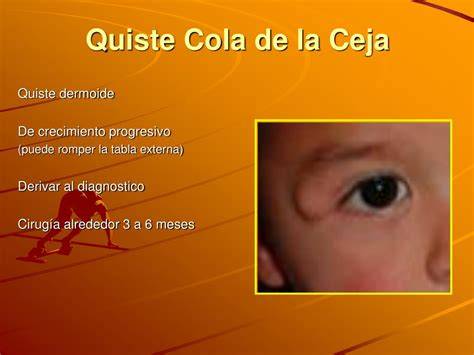 Quiste dermoide en cola de ceja infantil