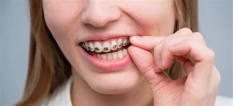 IPL en bozo con frenillos dentales