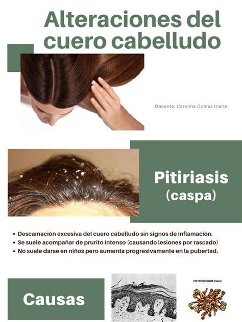 Rutas de metástasis del cuero cabelludo