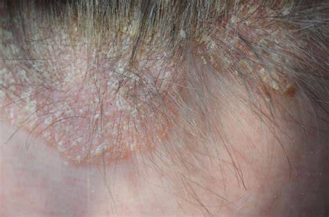 Psoriasis del cuero cabelludo con placas