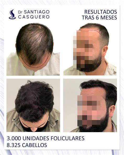 Cuero cabelludo con pérdida de densidad