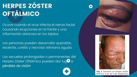 Herpes zóster en ceja y frente