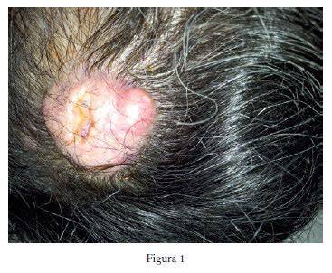 Carcinoma in situ en cuero cabelludo