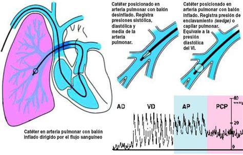 Catéter Swan-Ganz y presión capilar pulmonar