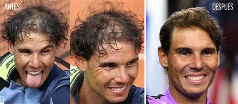 Rafa Nadal antes y después del trasplante capilar