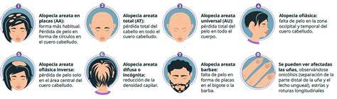 Tipos de alopecia areata infantil