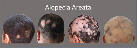 Comparación entre alopecia areata y poliosis