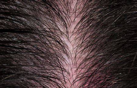 Cuero cabelludo sensible y cabello suave