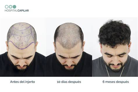 Cuero cabelludo 15 días tras injerto